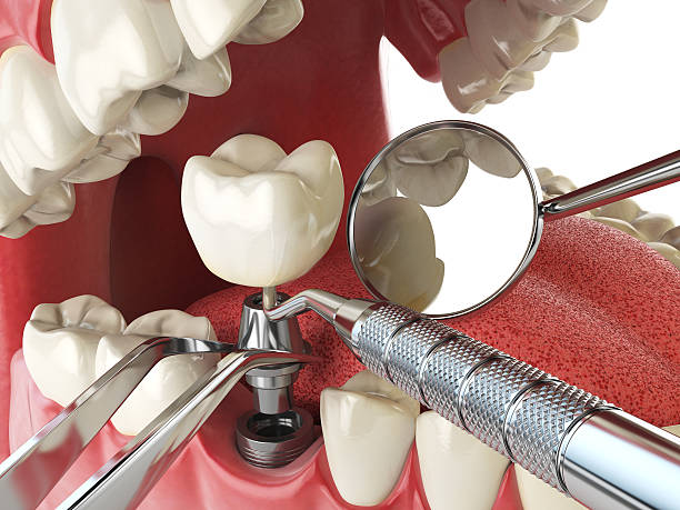 Best Knocked-Out Tooth (Avulsed Tooth) Treatment in Fairhope, PA