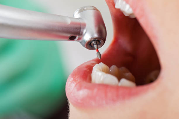 Best Emergency Wisdom Tooth Extraction in Fairhope, PA